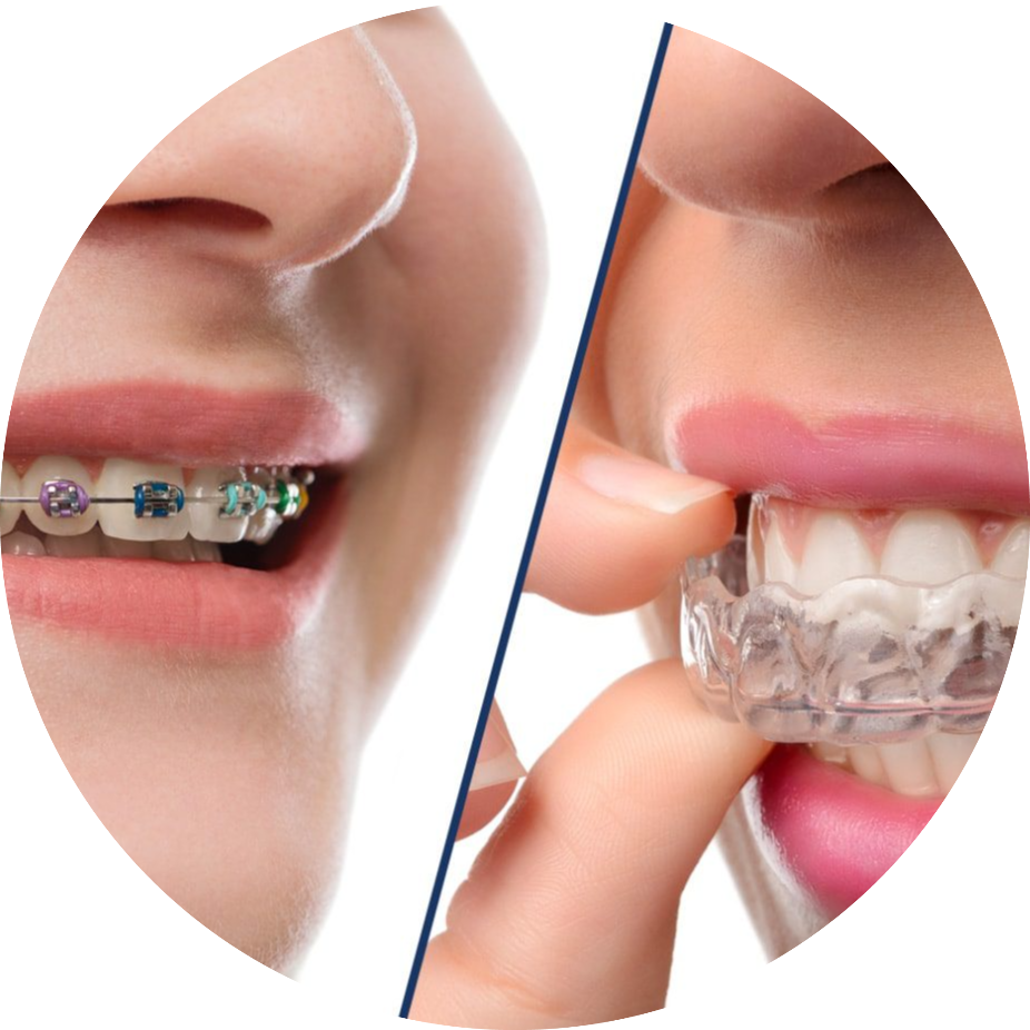 https://jonaclinic.ro/wp-content/uploads/2025/05/Traditional-Braces-vs.-Invisalign-fotor-2025052614524.png